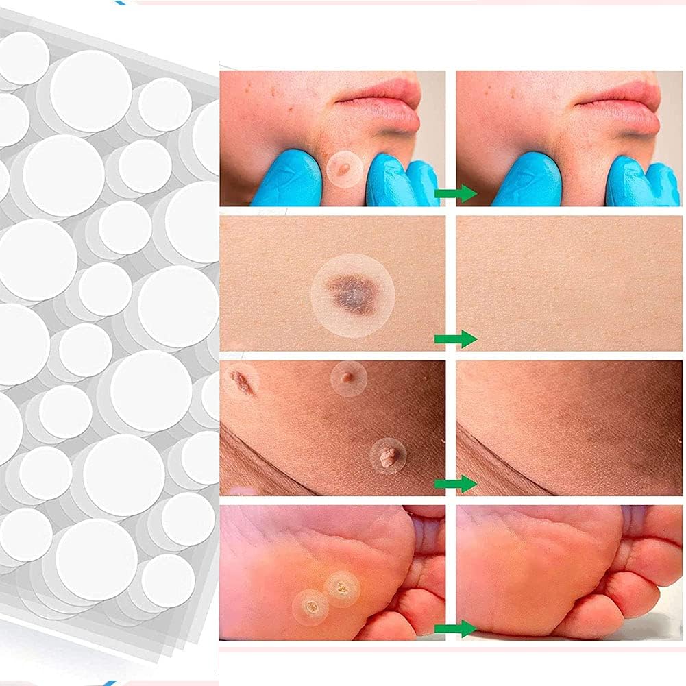 Xinchangda Anti-Verrues Pour Enlever Les Grains De Beauté, Callosités Et Le Cou Plat Verrues Du Visage - Efficace Sans Rayures , 108 Unité (Lot 1) 1 unité (Lot de 1)