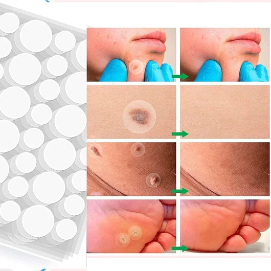 Xinchangda Anti-Verrues Pour Enlever Les Grains De Beauté, Callosités Et Le Cou Plat Verrues Du Visage - Efficace Sans Rayures , 108 Unité (Lot 1) 1 unité (Lot de 1)