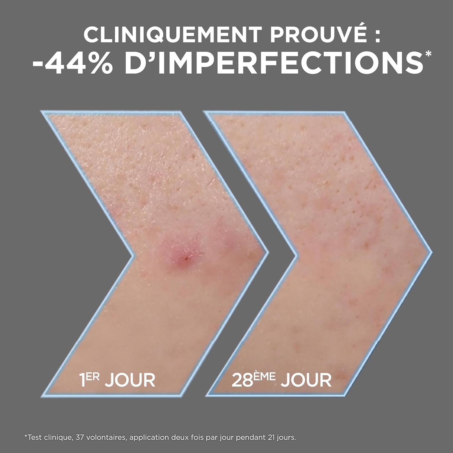 Pure Active - Sérum Anti-Points Noirs & Imperfections au Charbon - 4% Niacinamide, Acide Salicylique & Acide Lactique - Peaux Grasses à Tendance Acnéique - Vegan & Cruelty Free - 30 ml