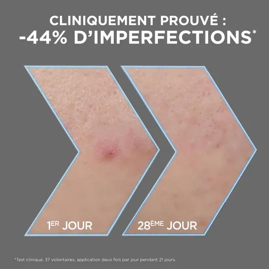 Pure Active - Sérum Anti-Points Noirs & Imperfections au Charbon - 4% Niacinamide, Acide Salicylique & Acide Lactique - Peaux Grasses à Tendance Acnéique - Vegan & Cruelty Free - 30 ml