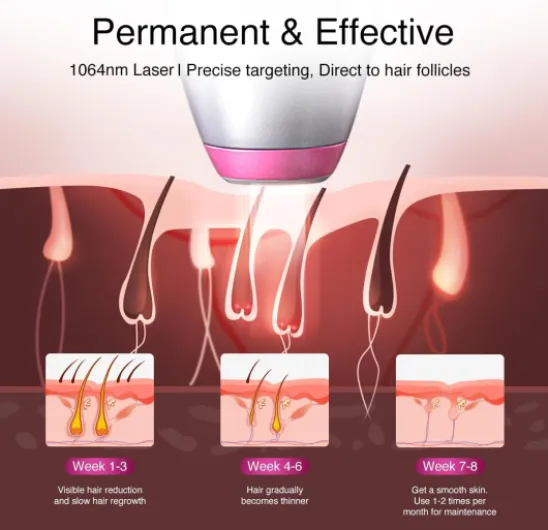 DermRays Épilation laser à diode 1064 nm pour femmes et hommes, pour tons de peau 1-6, refroidissement par glace, épilation grand angle pour le visage, le corps, pour les peaux profondes