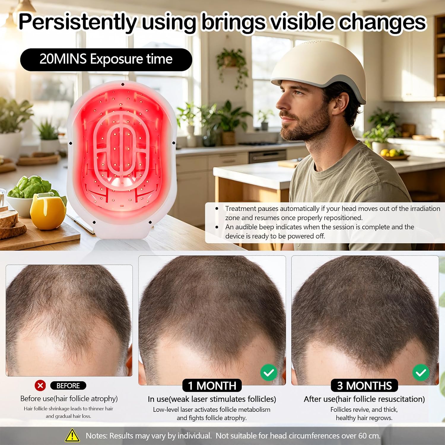 Casque Laser LLLT contre la chute des cheveux, système de thérapie lumière rouge pour la repousse avec 268 diodes laser 650 nm, sans fil jusqu’à 2 h d’autonomie, soin du cuir chevelu pour fem